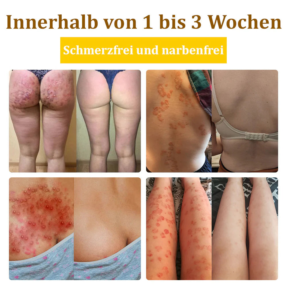 Bostore™ Bienengift-Therapie-Creme, zur Behandlung von Ekzemen, Akne, Altersflecken, Krampfadern, Hautrissen, Pilzinfektionen und Warzen sowie anderen Hautproblemen.👨⚕️