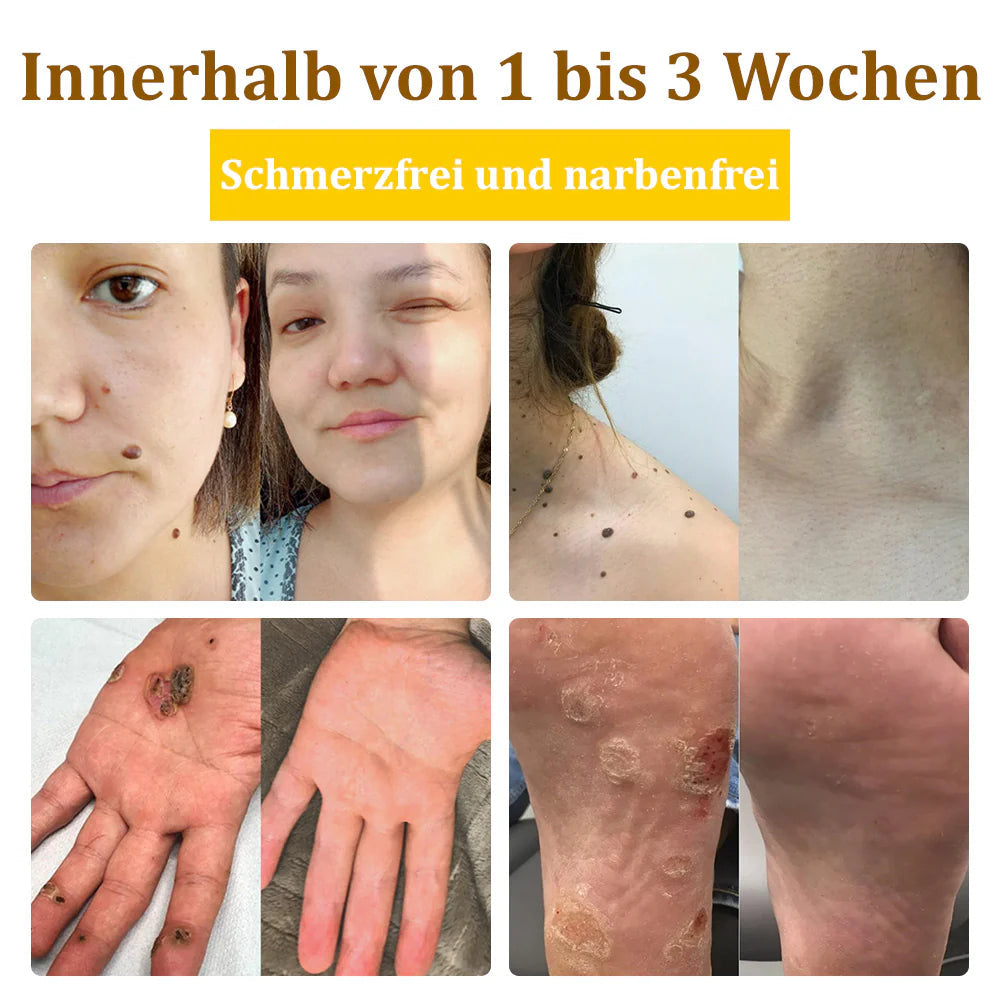 Bostore™ Bienengift-Therapie-Creme, zur Behandlung von Ekzemen, Akne, Altersflecken, Krampfadern, Hautrissen, Pilzinfektionen und Warzen sowie anderen Hautproblemen.👨⚕️