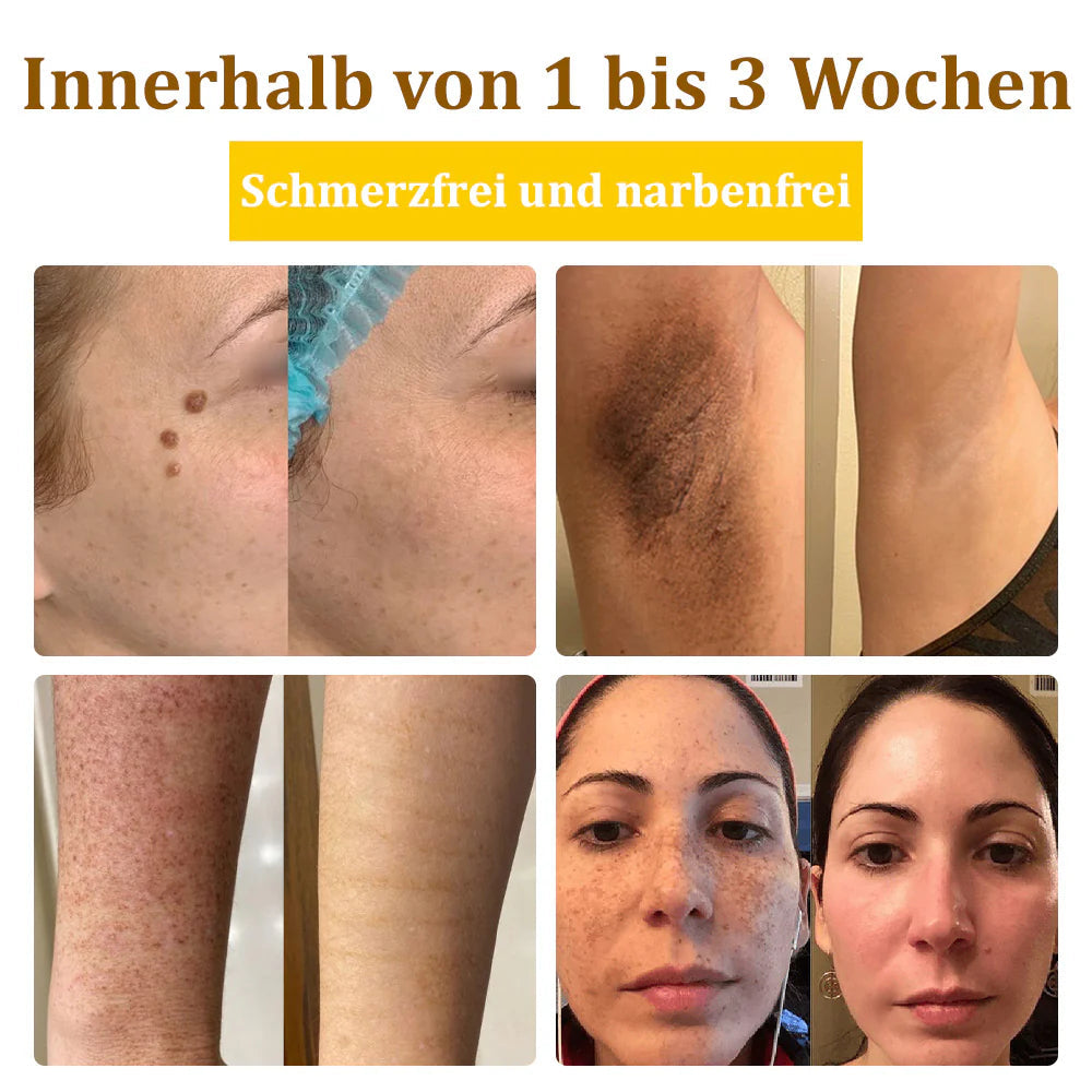 Bostore™ Bienengift-Therapie-Creme, zur Behandlung von Ekzemen, Akne, Altersflecken, Krampfadern, Hautrissen, Pilzinfektionen und Warzen sowie anderen Hautproblemen.👨⚕️